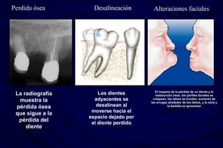 La radiografía
muestra la
pérdida ósea
que sigue a la
pérdida del
diente
Los dientes
adyacentes se
desalinean al
moverse hacia el
espacio dejado por
el diente perdido
El impacto de la pérdida de un diente y la
reabsorción ósea: los perfiles faciales se
colapsan, los labios se hunden, aumento de
las arrugas alrededor de los labios, y la nariz y
la barbilla se aproximan
Perdida ósea Desalineación Alteraciones faciales
 