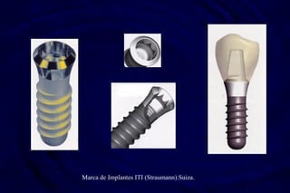 Marca de Implantes ITI (Straumann).Suiza.
 