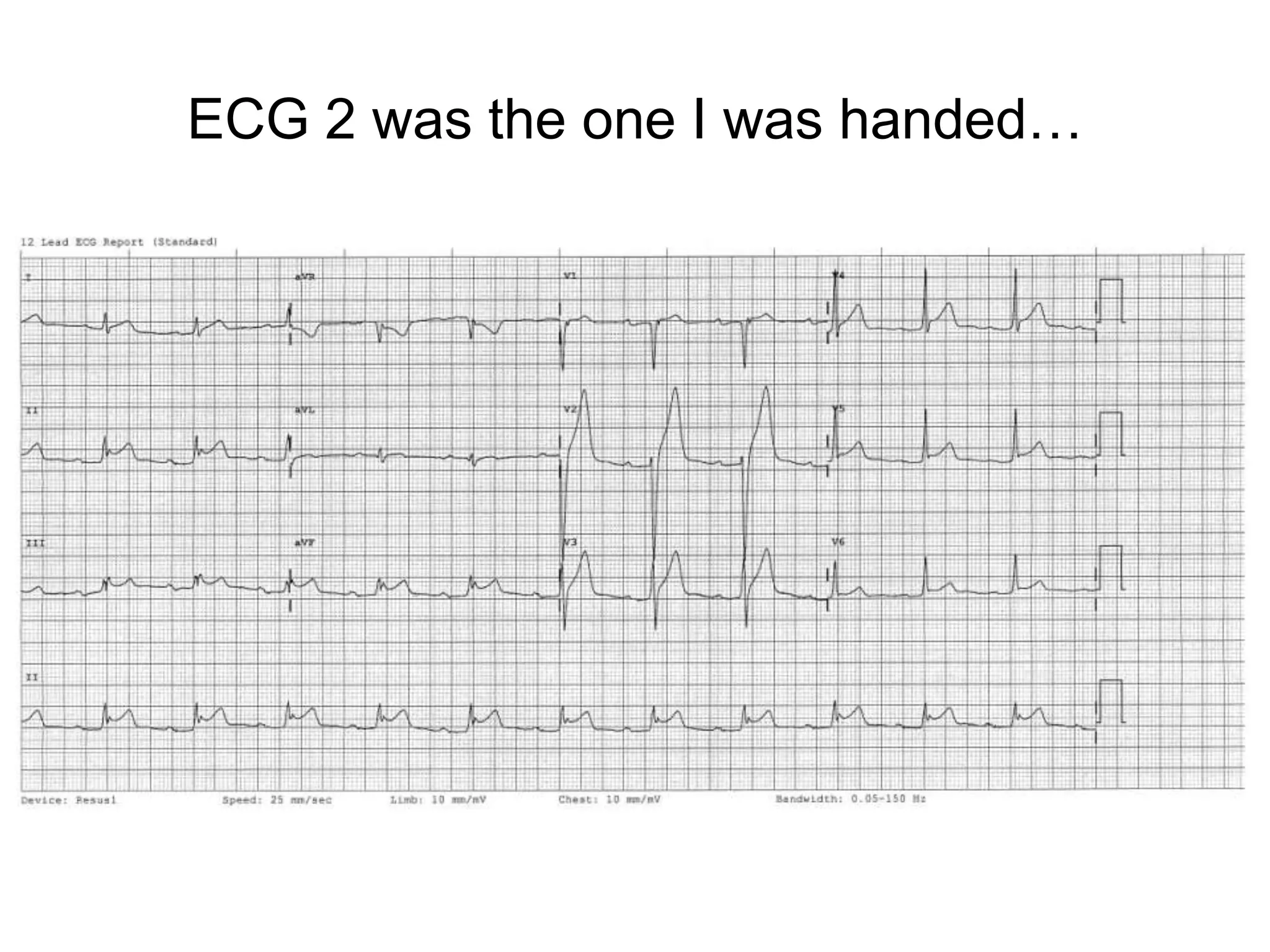 ECG 2 was the one I was handed…
 
