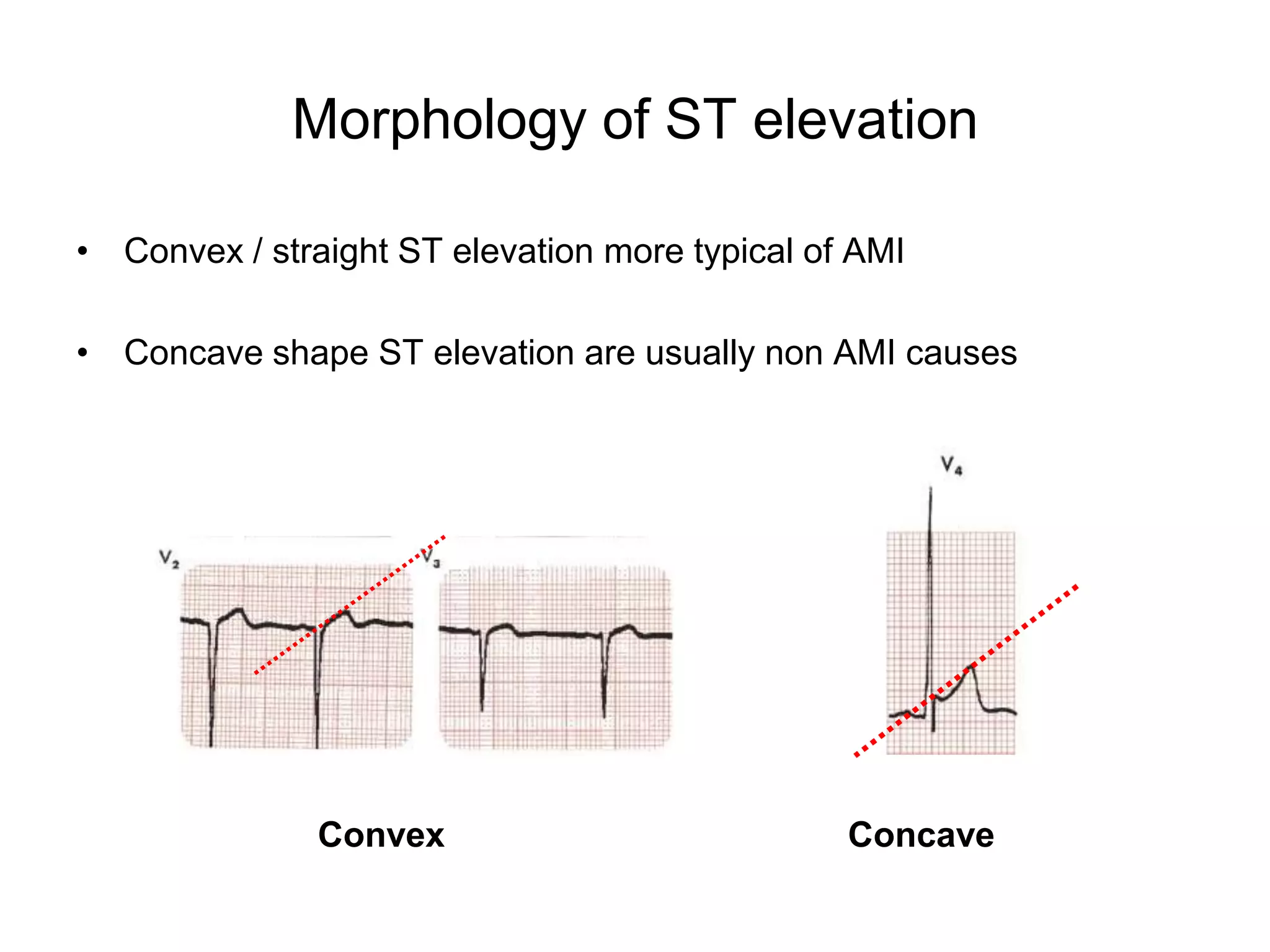 Morphology of ST elevation

• Convex / straight ST elevation more typical of AMI

• Concave shape ST elevation are usually non AMI causes




               Convex                           Concave
 