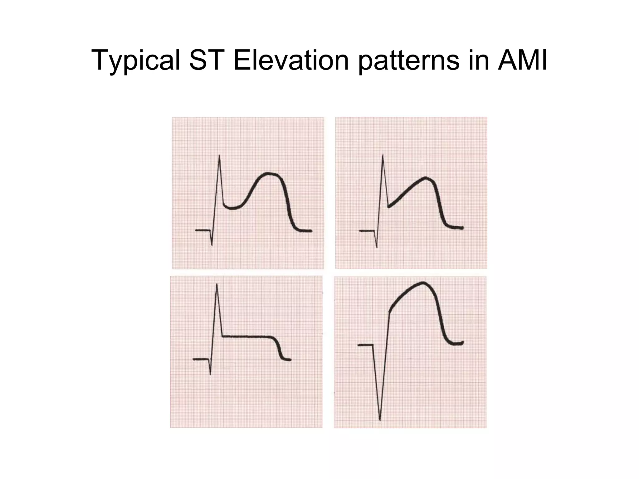 Typical ST Elevation patterns in AMI
 