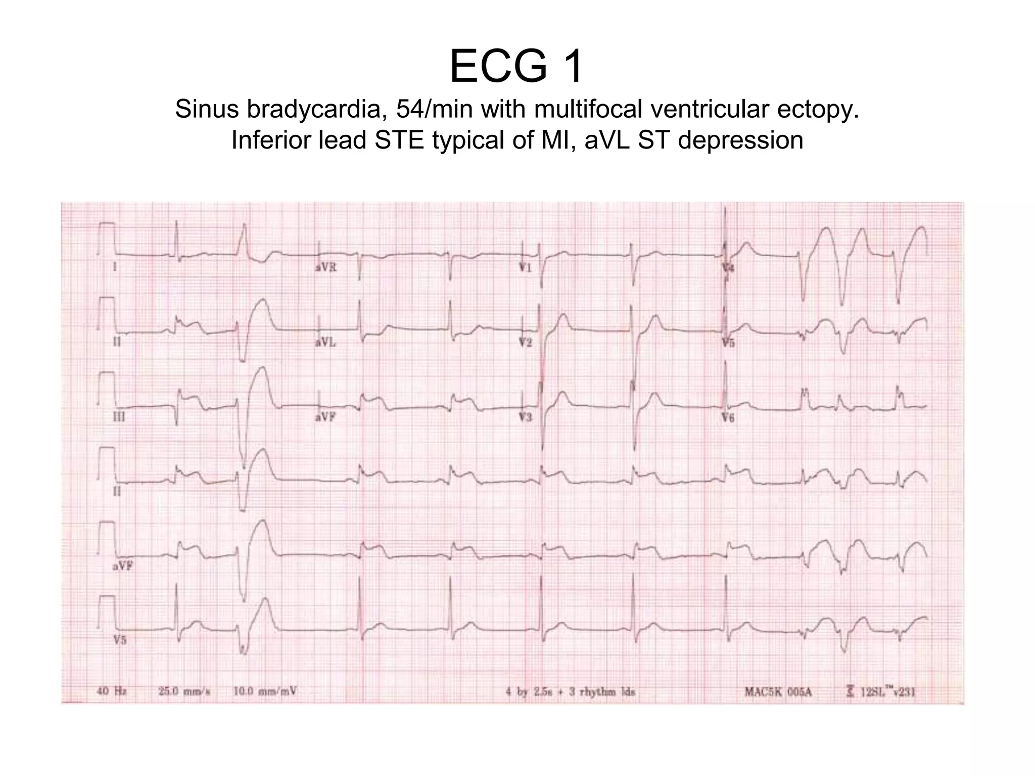 ECG 1
Sinus bradycardia, 54/min with multifocal ventricular ectopy.
    Inferior lead STE typical of MI, aVL ST depression
 