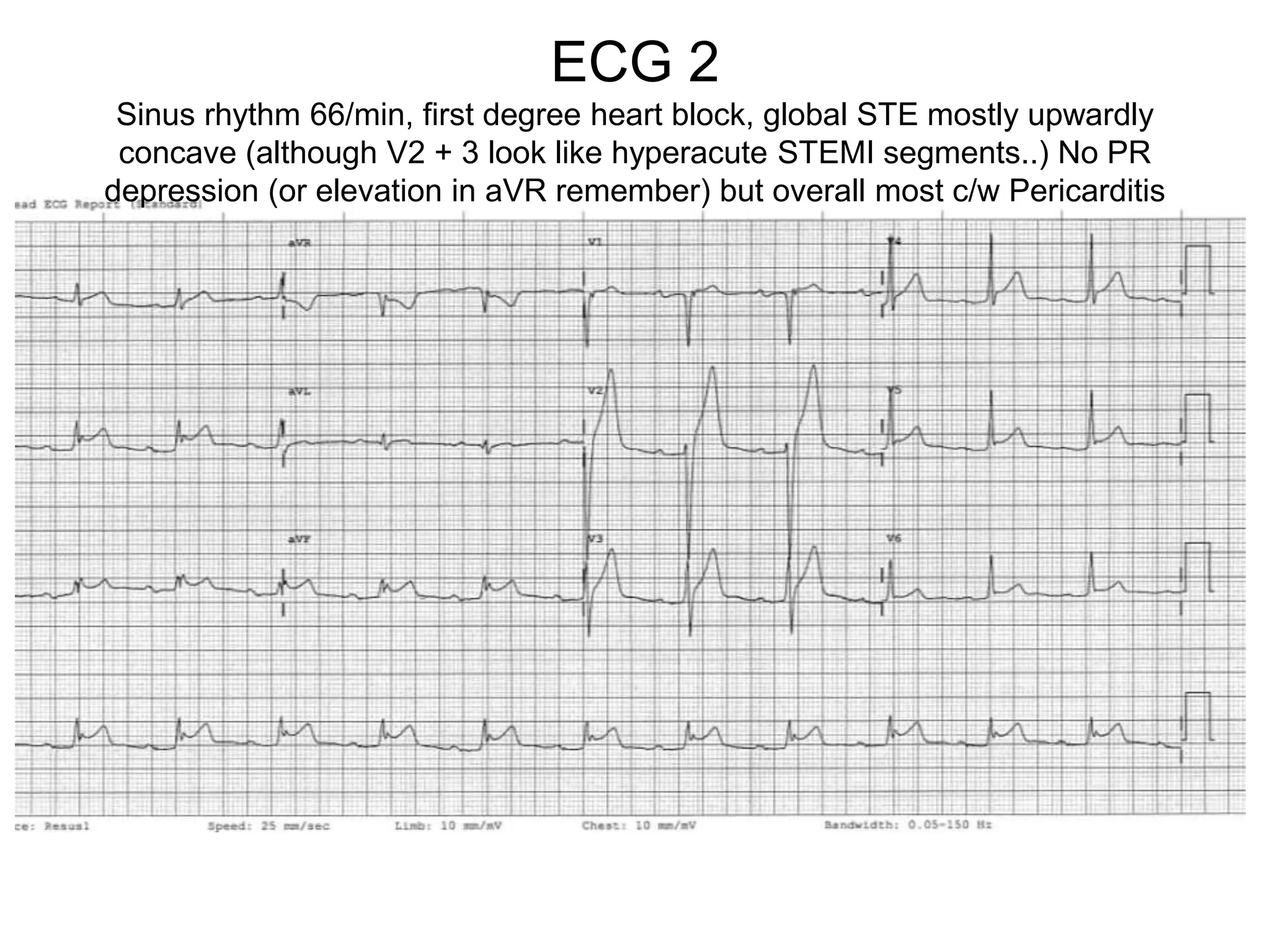 ECG 2
 Sinus rhythm 66/min, first degree heart block, global STE mostly upwardly
 concave (although V2 + 3 look like hyperacute STEMI segments..) No PR
depression (or elevation in aVR remember) but overall most c/w Pericarditis
 