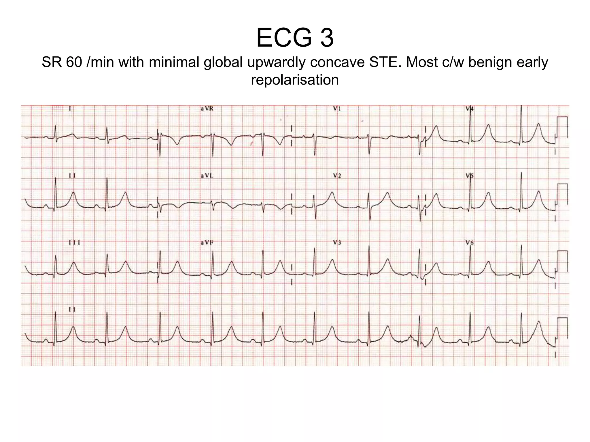 ECG 3
SR 60 /min with minimal global upwardly concave STE. Most c/w benign early
                               repolarisation
 