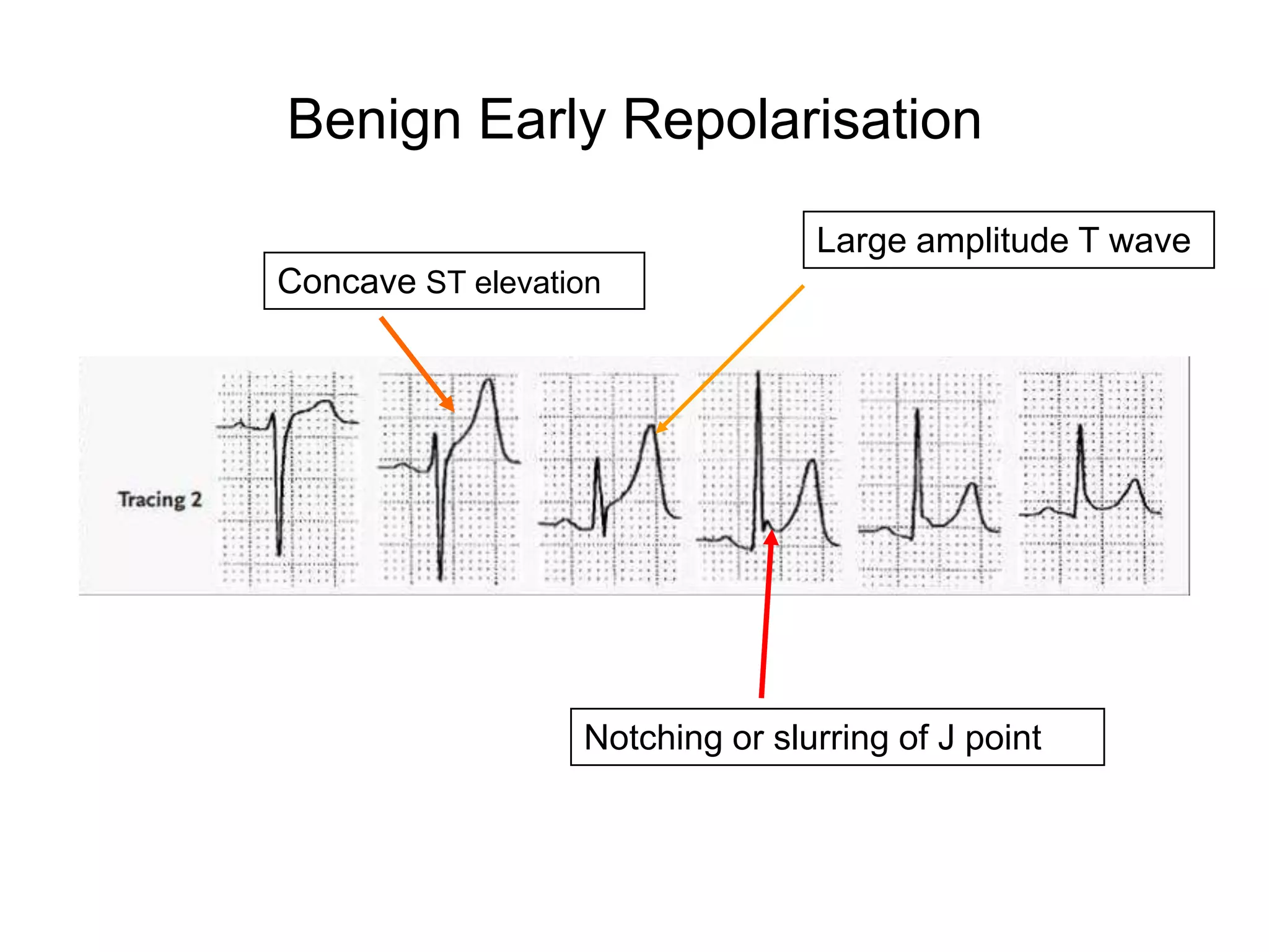 Benign Early Repolarisation

                                 Large amplitude T wave
Concave ST elevation




                  Notching or slurring of J point
 