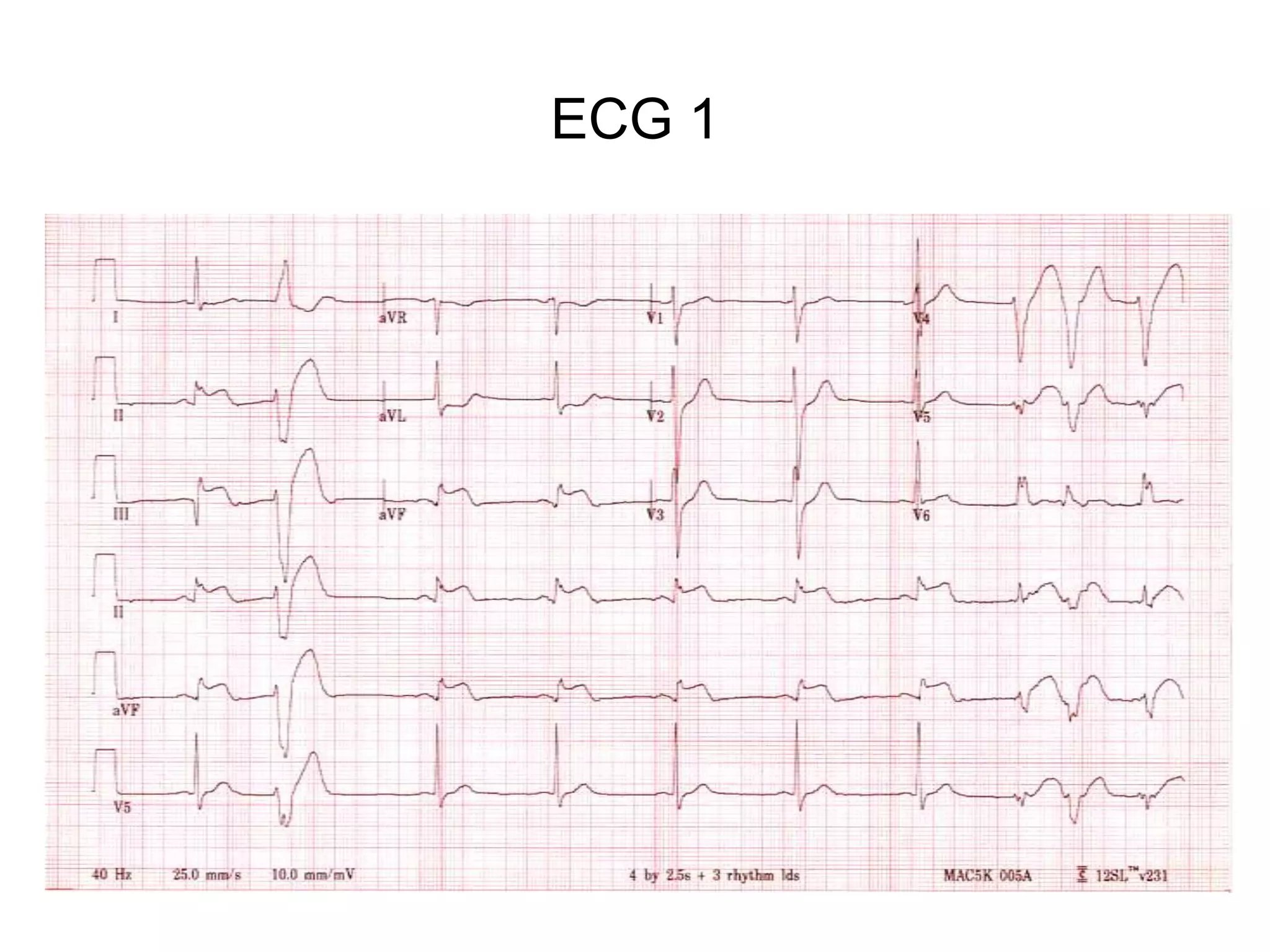 ECG 1
 