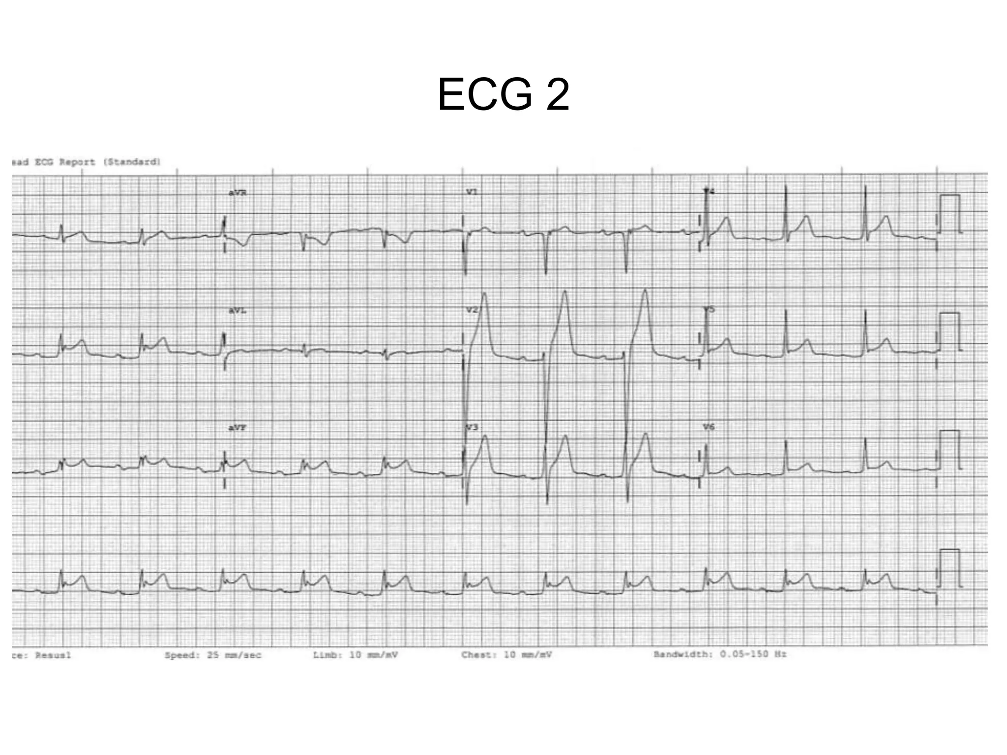 ECG 2
 