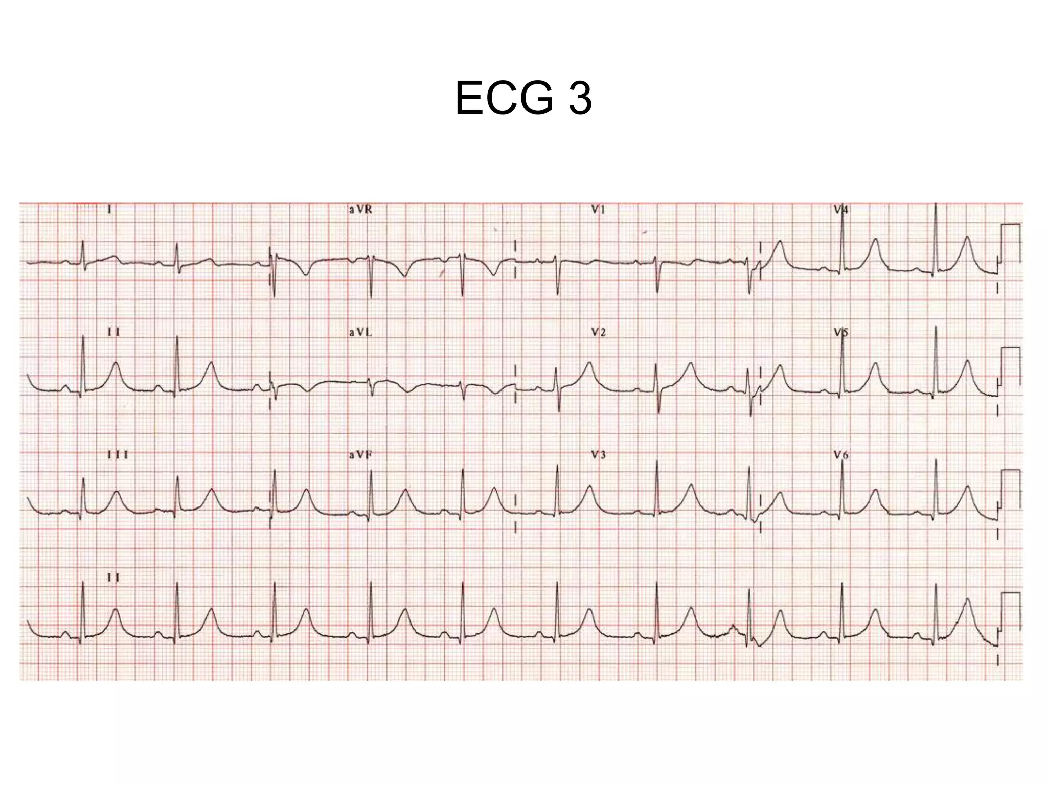 ECG 3
 