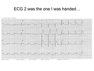 ECG 2 was the one I was handed…
 