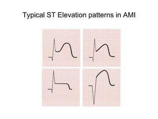 Typical ST Elevation patterns in AMI
 