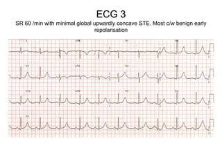 ECG 3
SR 60 /min with minimal global upwardly concave STE. Most c/w benign early
                               repolarisation
 