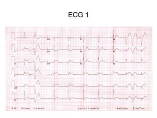 ECG 1
 