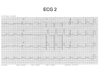 ECG 2
 