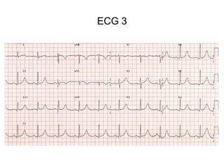 ECG 3
 