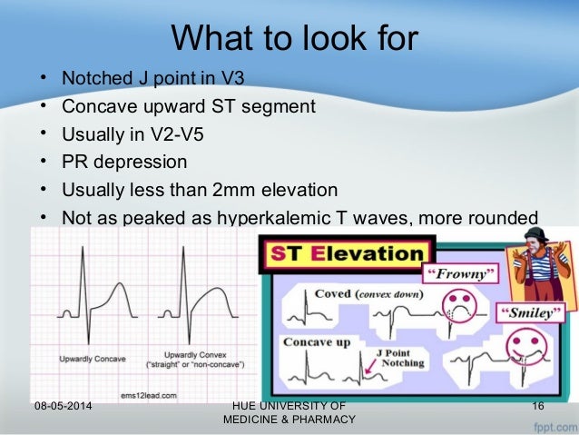ST elevation