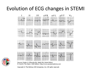 St elevation myocardial infarction | PDF