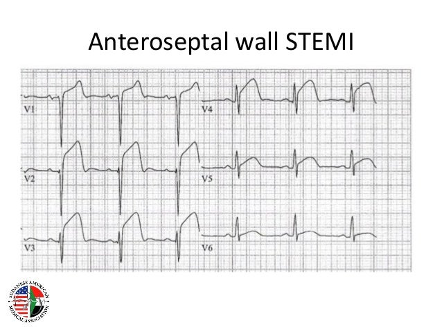 st elevation myocardial infarction
