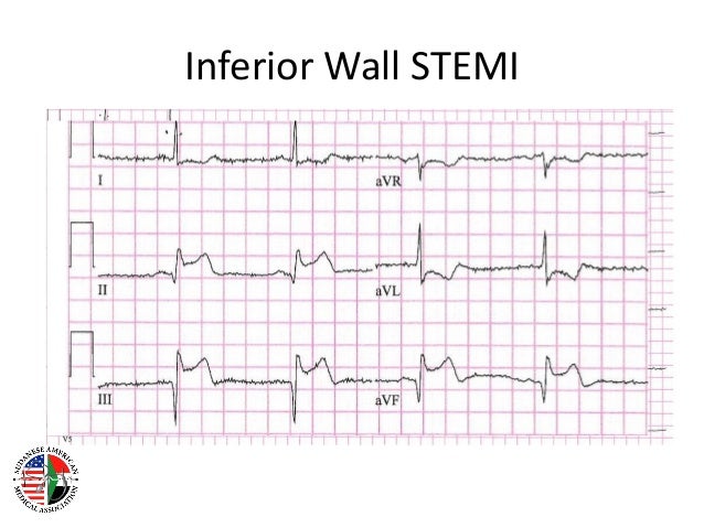 st elevation myocardial infarction st elevation myocardial infarction
