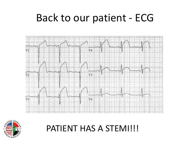 st elevation myocardial infarction st elevation myocardial infarction