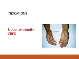 Upper extremity
CRPS
INDICATIONS
 