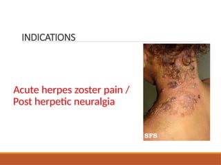 Acute herpes zoster pain /
Post herpetic neuralgia
INDICATIONS
 