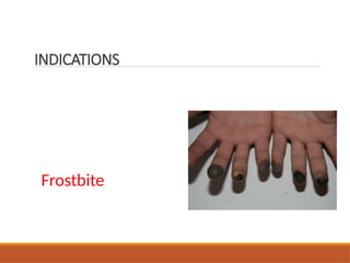 Frostbite
INDICATIONS
 