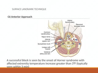 SURFACE LANDMARK TECHNIQUE
C6 Anterior Approach
A successful block is seen by the onset of Horner syndrome with
affected extremity temperature increase greater than 3°F (typically
seen within 3 min)
 