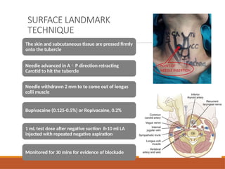 SURFACE LANDMARK
TECHNIQUE
The skin and subcutaneous tissue are pressed firmly
onto the tubercle
Needle advanced in AP direction retracting
Carotid to hit the tubercle
Needle withdrawn 2 mm to to come out of longus
colli muscle
Bupivacaine (0.125-0.5%) or Ropivacaine, 0.2%
1 mL test dose after negative suction 8-10 ml LA
injected with repeated negative aspiration
Monitored for 30 mins for evidence of blockade
 