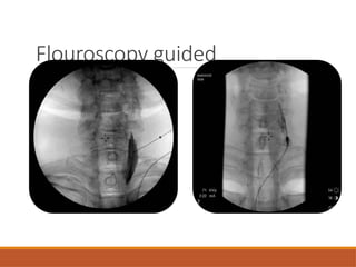 Flouroscopy guided
 
