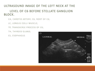 ULTRASOUND IMAGE OF THE LEFT NECK AT THE
LEVEL OF C6 BEFORE STELLATE GANGLION
BLOCK.
CA, CAROTID ARTERY; C6, ROOT OF C6;
LC, LONGUS COLLI MUSCLE;
TP, TRANSVERSE PROCESS OF C6;
TH, THYROID GLAND;
ES, ESOPHAGUS
 