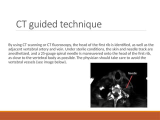 CT guided technique
By using CT scanning or CT fluoroscopy, the head of the first rib is identified, as well as the
adjacent vertebral artery and vein. Under sterile conditions, the skin and needle track are
anesthetized, and a 25-gauge spinal needle is maneuvered onto the head of the first rib,
as close to the vertebral body as possible. The physician should take care to avoid the
vertebral vessels (see image below).
 