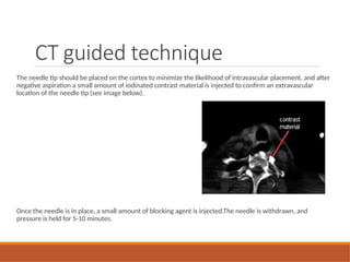 The needle tip should be placed on the cortex to minimize the likelihood of intravascular placement, and after
negative aspiration a small amount of iodinated contrast material is injected to confirm an extravascular
location of the needle tip (see image below).
Once the needle is in place, a small amount of blocking agent is injected.The needle is withdrawn, and
pressure is held for 5-10 minutes.
CT guided technique
 
