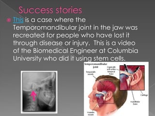 Success stories This is a case where the Temporomandibular joint in the jaw was recreated for people who have lost it through disease or injury.  This is a video of the Biomedical Engineer at Columbia University who did it using stem cells. 