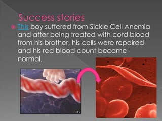 Success stories This boy suffered from Sickle Cell Anemia and after being treated with cord blood from his brother, his cells were repaired and his red blood count became normal.