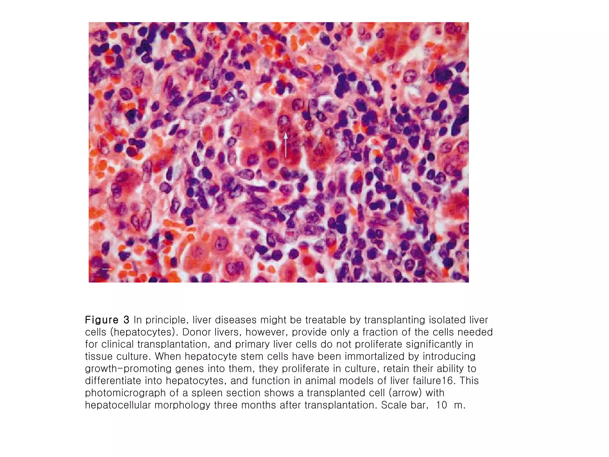 Figure 3  In principle, liver diseases might be treatable by transplanting isolated liver cells (hepatocytes). Donor livers, however, provide only a fraction of the cells needed for clinical transplantation, and primary liver cells do not proliferate significantly in tissue culture. When hepatocyte stem cells have been immortalized by introducing growth-promoting genes into them, they proliferate in culture, retain their ability to differentiate into hepatocytes, and function in animal models of liver failure16. This photomicrograph of a spleen section shows a transplanted cell (arrow) with hepatocellular morphology three months after transplantation. Scale bar,  10  m. 