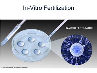 In-Vitro Fertilization
 