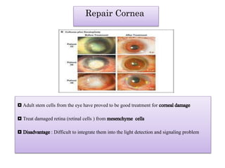 Repair Cornea
◘Adult stem cells from the eye have proved to be good treatment for cornealdamage
◘ Treat damaged retina (retinal cells ) from mesenchyme cells
◘ Disadvantage: Difficult to integrate them into the light detection and signaling problem
 