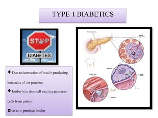 TYPE 1 DIABETICS
♦ Due to destruction of insulin producing
beta cells of the pancreas
♦ Embryonic stem cell existing pancreas
cells from patient
◘ so as to produce Insulin
 