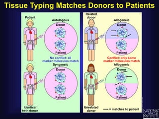 Tissue Typing Matches Donors to Patients
Allogeneic
Patient
= matches to patient
Conflict: only some
marker molecules match
No conflict: all
marker molecules match
Patient
Syngeneic
Autologous
Donor
Identical
twin donor
Unrelated
donor
Related
donor
Allogeneic
Patient
Donor
Patient
Donor
Patient
Donor
 