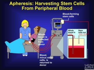 Apheresis: Harvesting Stem Cells
From Peripheral Blood
Whole
blood is
collected
from
donor
Blood,
minus stem
cells, is
returned to
donor
Stem
cells out
Whole
blood in
Blood-forming
stem cells
 