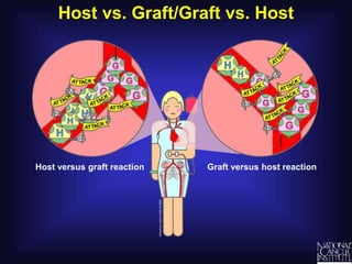 Host vs. Graft/Graft vs. Host
Host versus graft reaction Graft versus host reaction
 