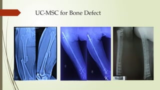 UC-MSC for Bone Defect
 