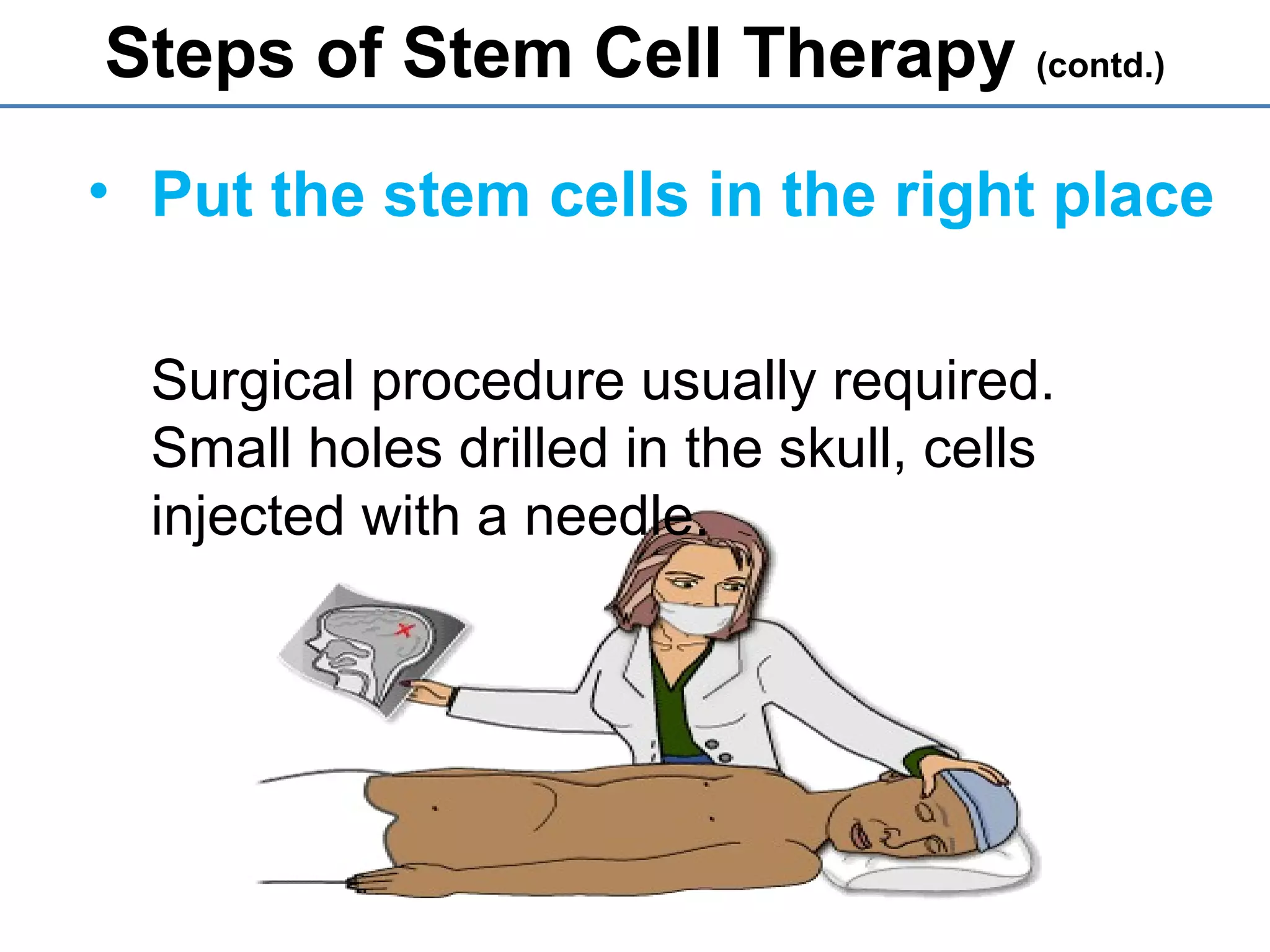 • Put the stem cells in the right place
Surgical procedure usually required.
Small holes drilled in the skull, cells
injected with a needle.
Steps of Stem Cell Therapy (contd.)
 
