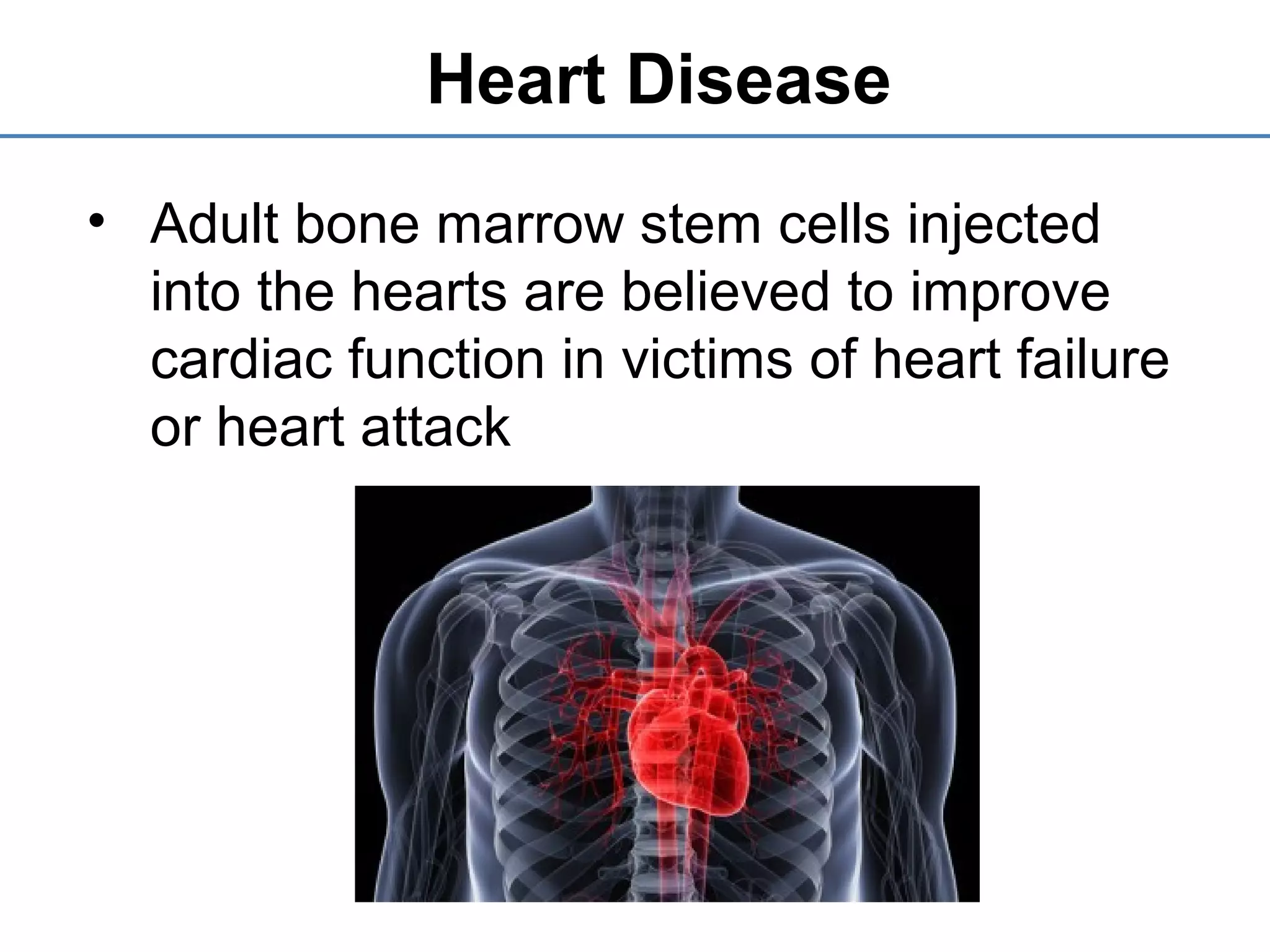 Heart Disease
• Adult bone marrow stem cells injected
into the hearts are believed to improve
cardiac function in victims of heart failure
or heart attack
 