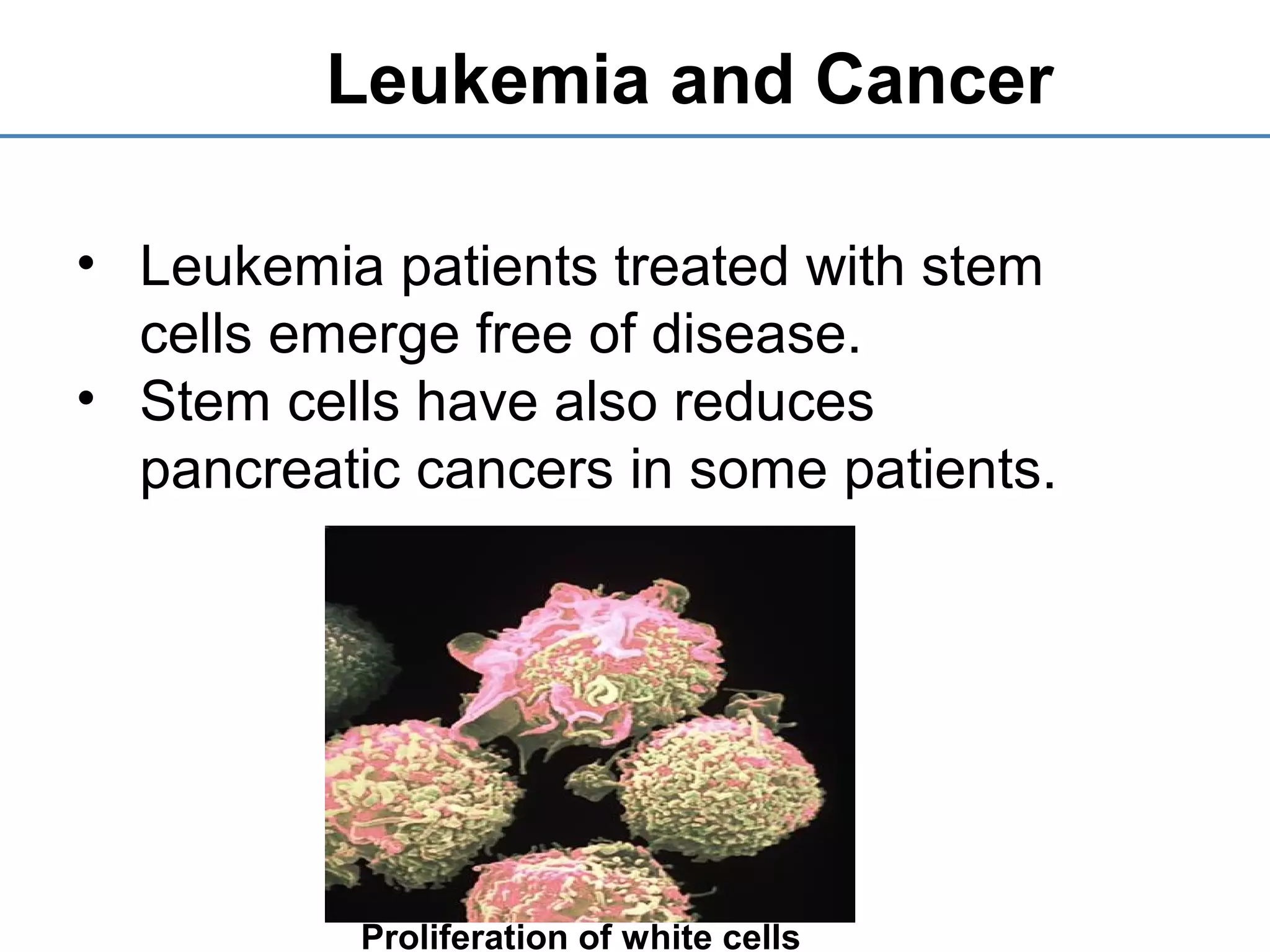 Leukemia and Cancer
• Leukemia patients treated with stem
cells emerge free of disease.
• Stem cells have also reduces
pancreatic cancers in some patients.
Proliferation of white cells
 