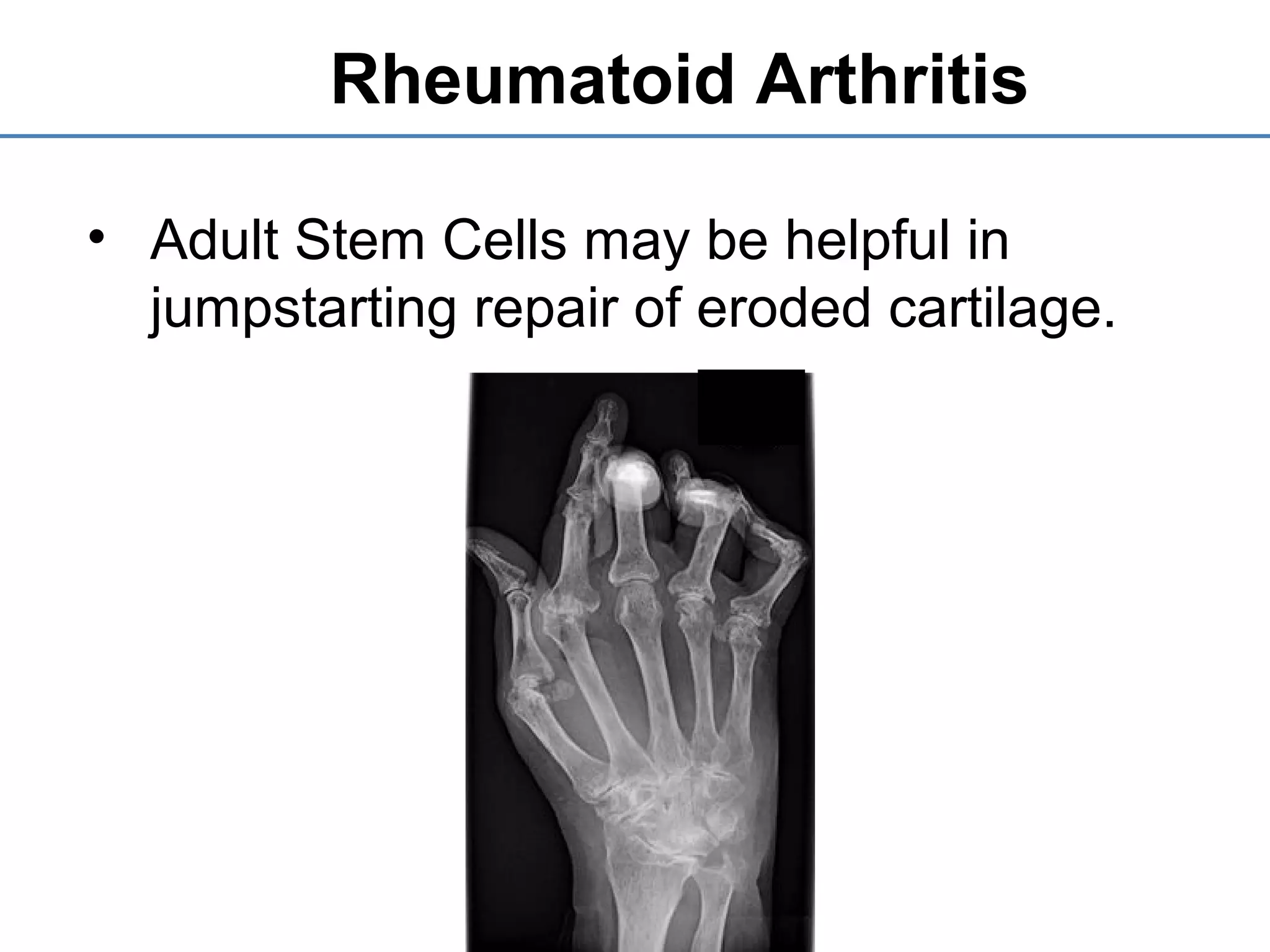 Rheumatoid Arthritis
• Adult Stem Cells may be helpful in
jumpstarting repair of eroded cartilage.
 