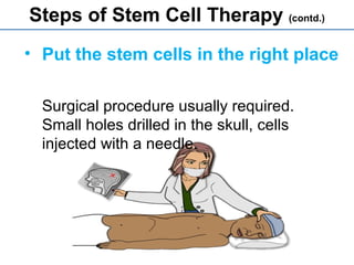 • Put the stem cells in the right place
Surgical procedure usually required.
Small holes drilled in the skull, cells
injected with a needle.
Steps of Stem Cell Therapy (contd.)
 