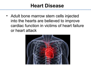 Heart Disease
• Adult bone marrow stem cells injected
into the hearts are believed to improve
cardiac function in victims of heart failure
or heart attack
 