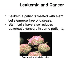 Leukemia and Cancer
• Leukemia patients treated with stem
cells emerge free of disease.
• Stem cells have also reduces
pancreatic cancers in some patients.
Proliferation of white cells
 