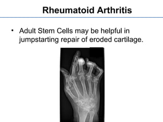 Rheumatoid Arthritis
• Adult Stem Cells may be helpful in
jumpstarting repair of eroded cartilage.
 